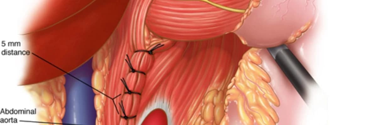 Uşaqlarda anadangəlmə diafraqma yırtığı: Diafraqmanın yırtılması