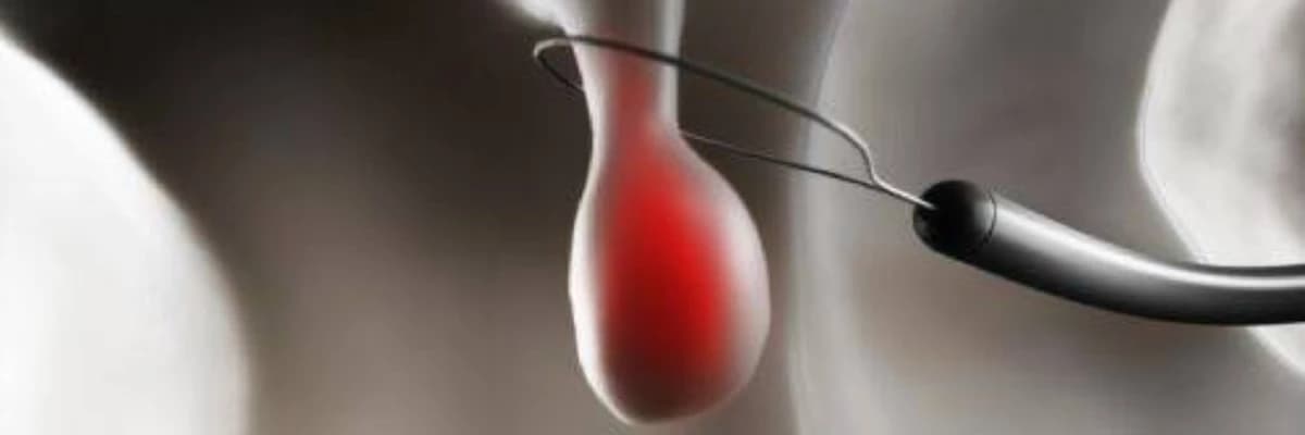 Yogun bagirsagin polipleri