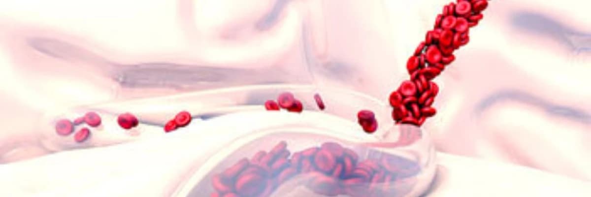 Periferik Arter Xəstəliyi