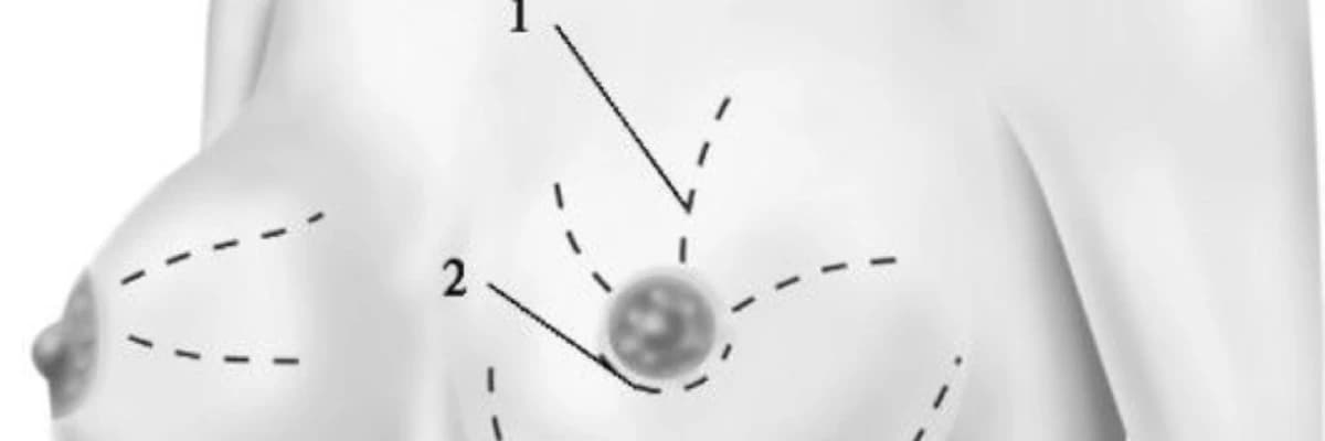 Döş vəzilərinin biopsiyası və patologiyası