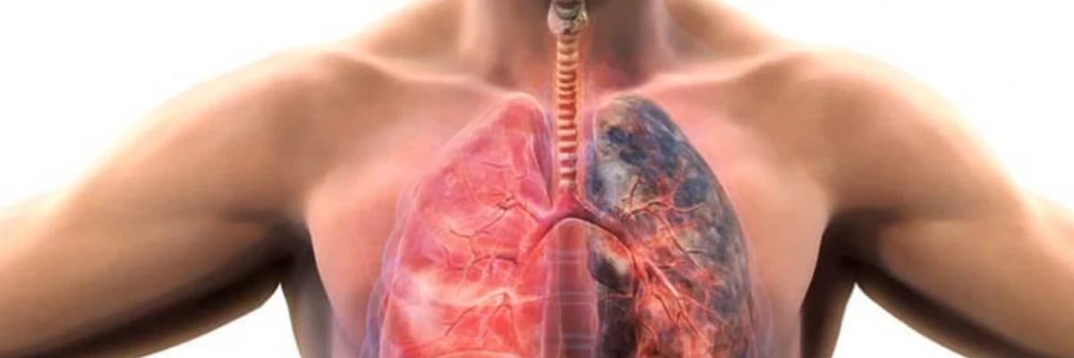 Xroniki Obstruktiv Ağciyər Xəstəliyi (KOAH): Tənəffüs sisteminə təsir edən ciddi sağlamlıq problemi