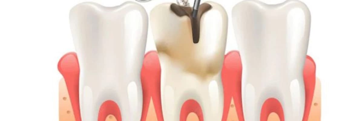 dis koku infeksiyasi nedir