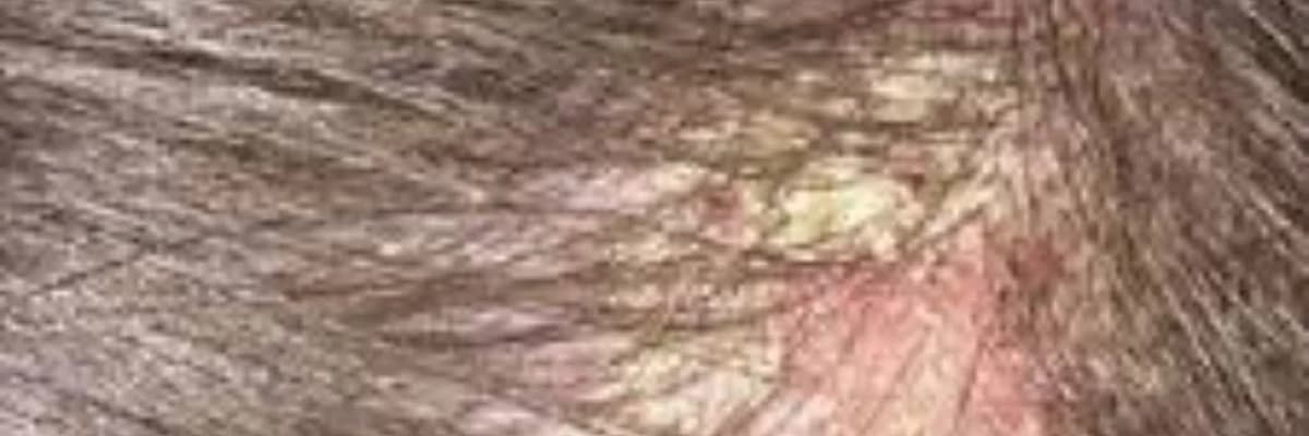 Saç xəstəlikləri