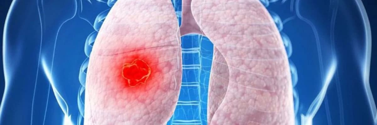 Ağciyər düyünləri