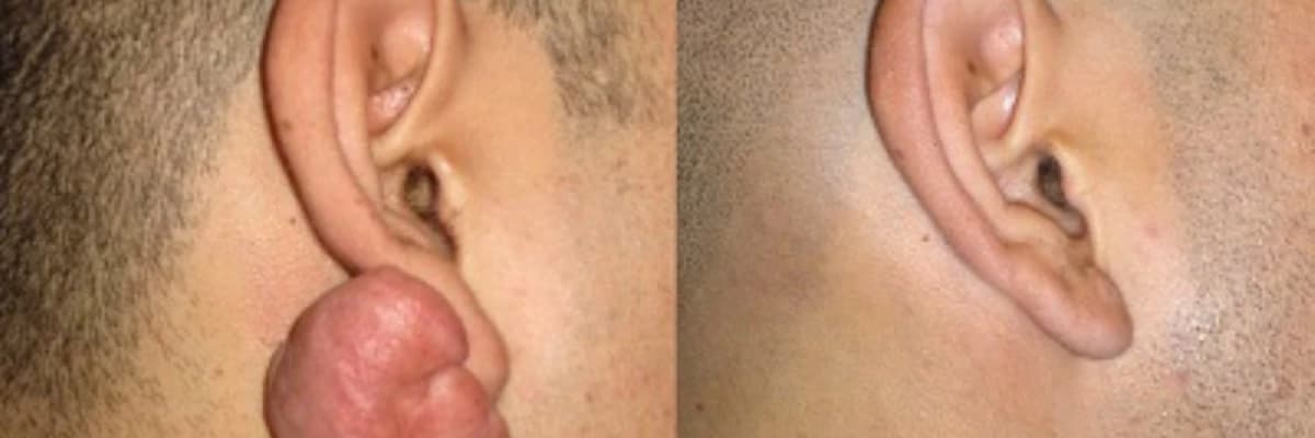 Qulaq seyvanından xoşxasssəli törəmələrin götürülməsi (keloid, lipoma və s)