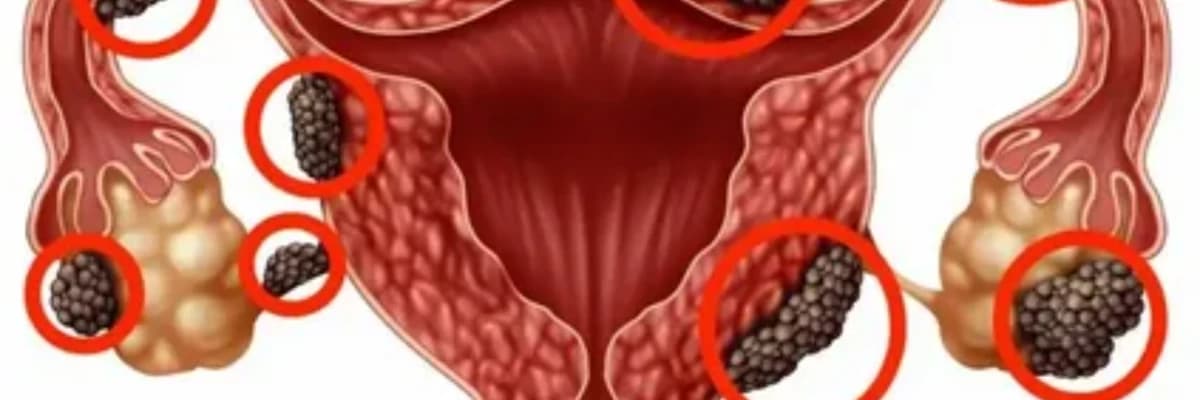 Endometriozun əlamətləri hansılardır?