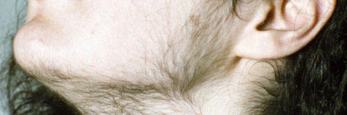 Hirsutizm (həddindən artıq saç böyüməsi)