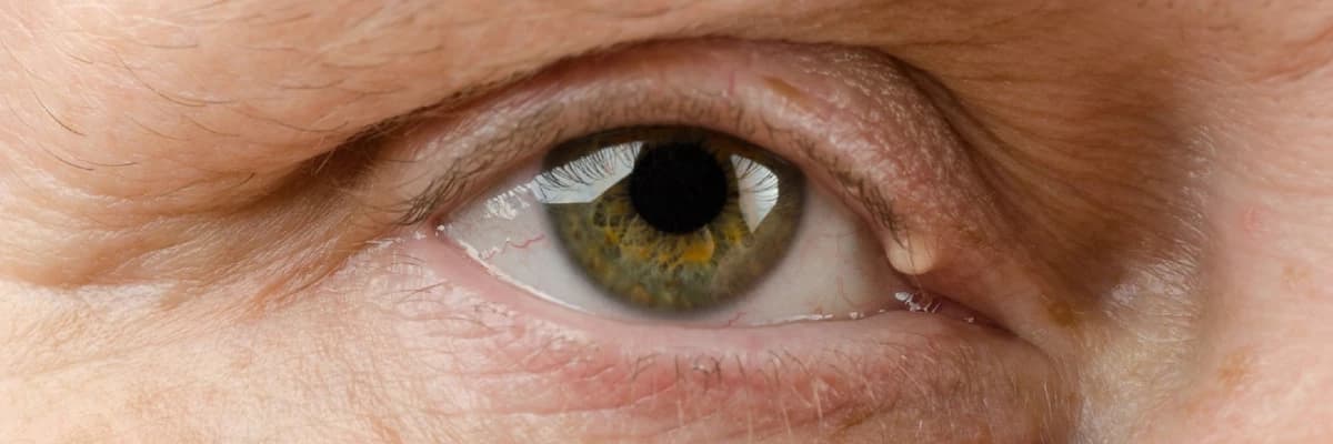 GÖZDAXİLİ İLTİHABLAR