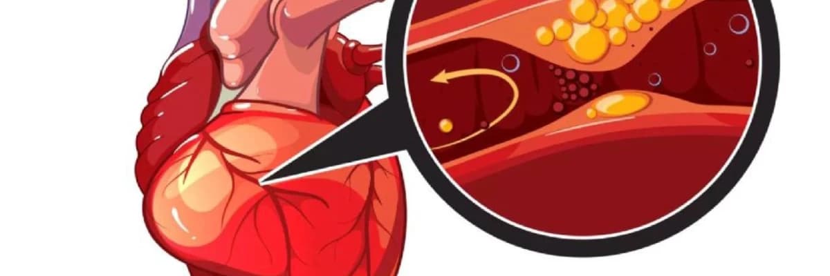 Koronar Arteriya Xəstəliyi
