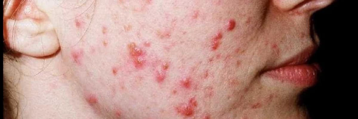 Akne Vulgaris: Sivilcə Problemləri və Onların Müalicəsi