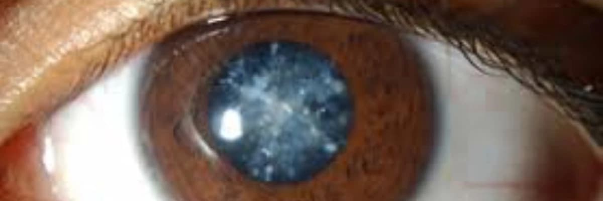 Katarakta (gözün təbii linzasının bulanması)