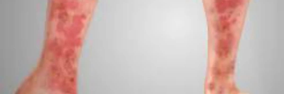 Allergik enteropatiya