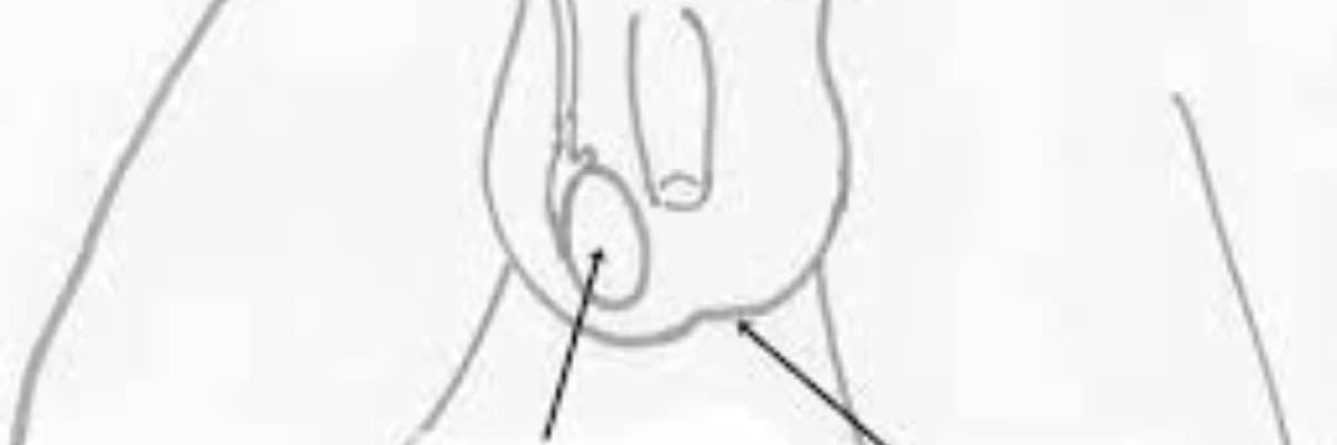 Oğlanlarda testislərin burulması: simptomlar, səbəblər və müalicə