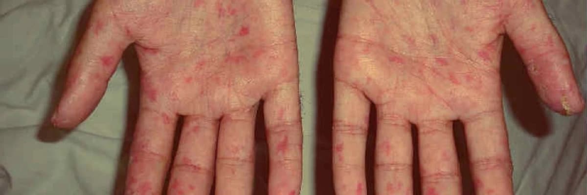 Sistem skeroz (sklerodermiya)