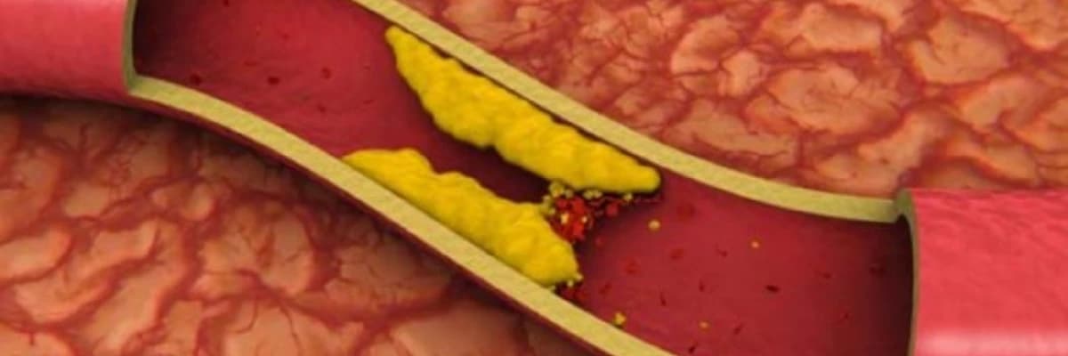 Xolesterin və triqliserid kimi qan yağlarında yüksəlmə