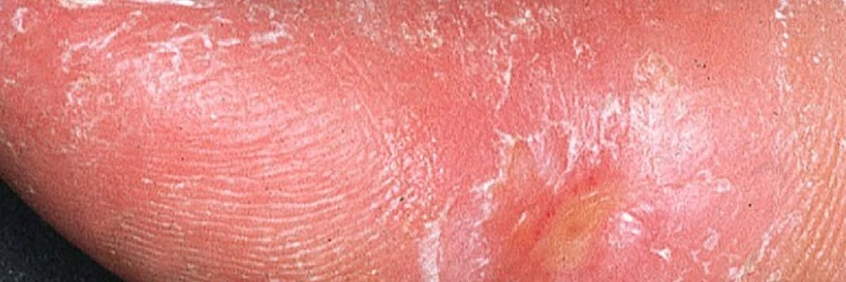 Sistem skleroz (skleroderma)