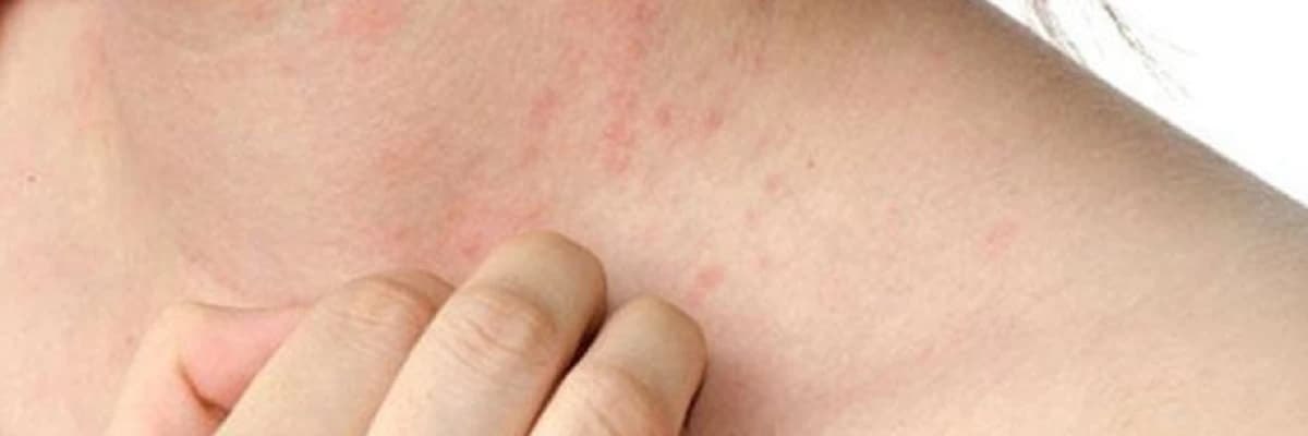 Yazın ən aktiv allergik xəstəliyi