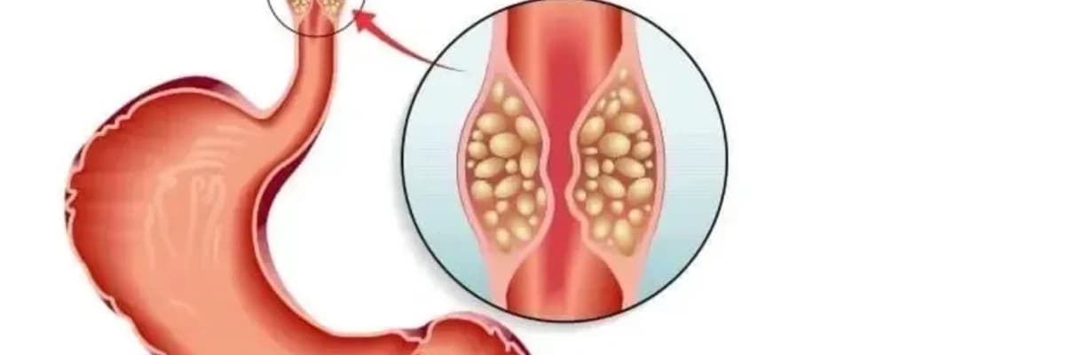 Qida borusu xərçənginin əməliyyatları