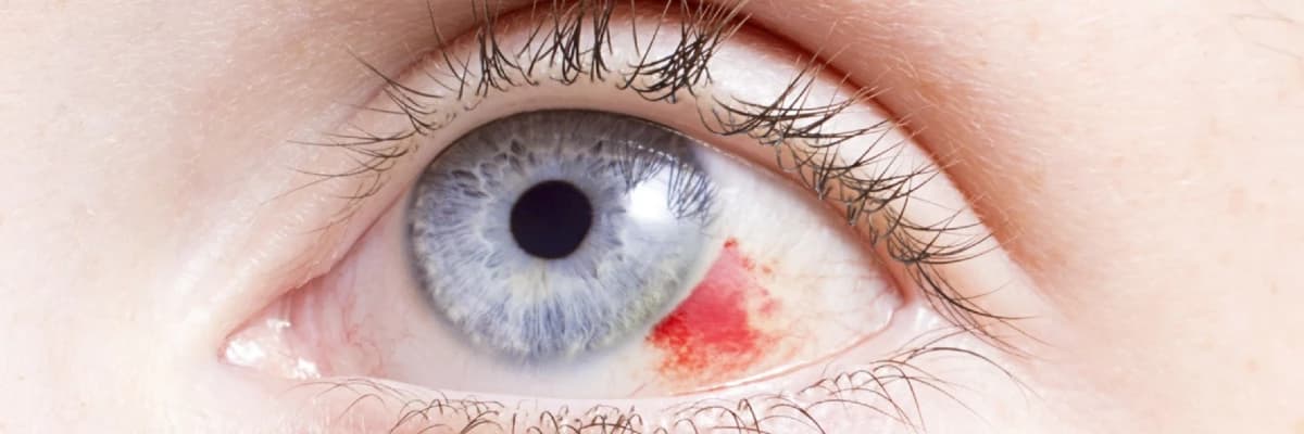 Gözə yad bir cismin yapışması hissi