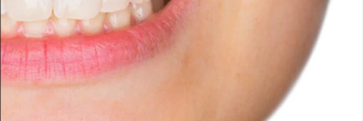 Diş əti iltihabının (gingivitis) müalicəsi