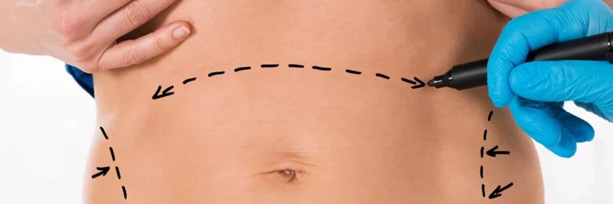 Abdominoplastika: Qarın Estetiği və Funksional Korreksiya Cərrahiyyəsi