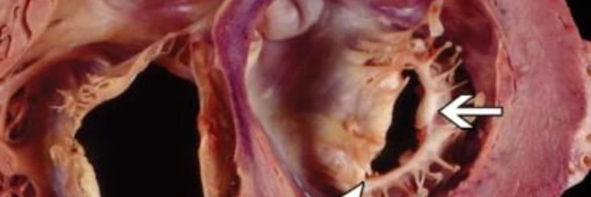 Revmatizmal ürək xəstəlikləri