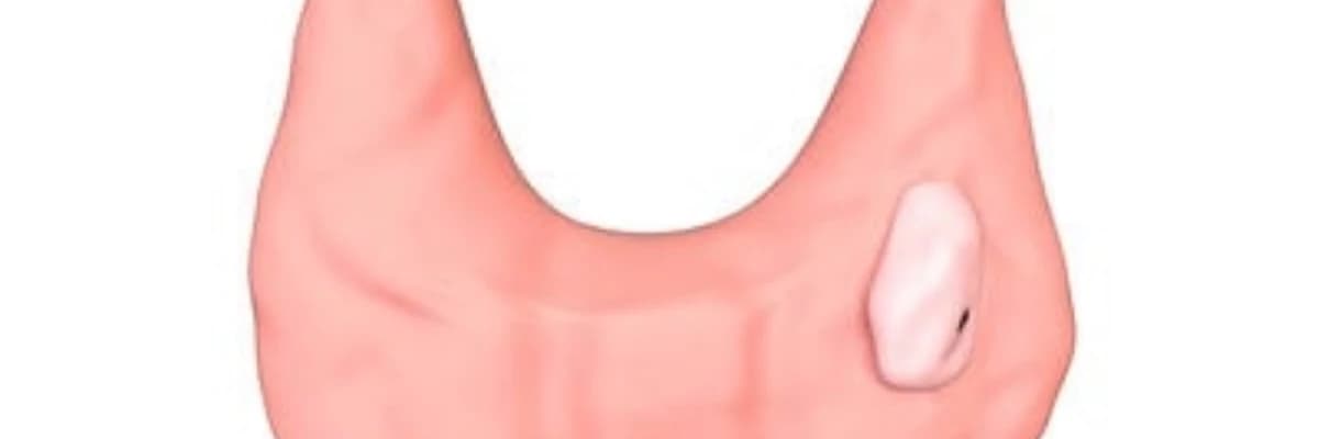 Tiroid neoplaziyaları