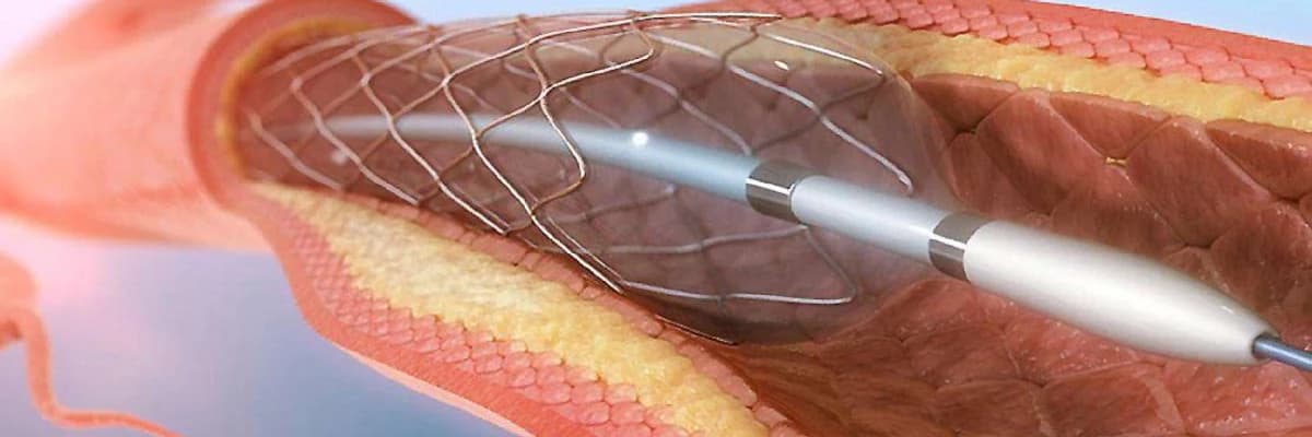 Koronar angioplastika: Ürək damarlarının yenidən açılması