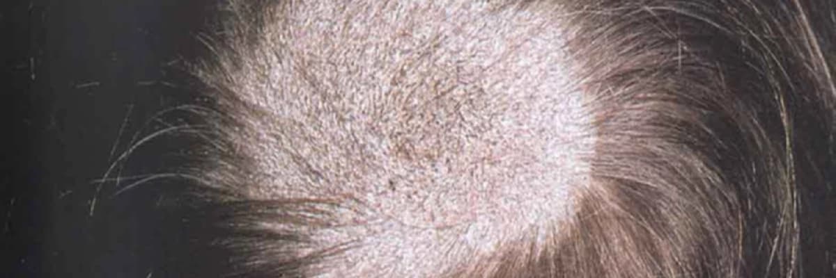 Tinea Capitis (Saçlı Dərinin Göbələyi)