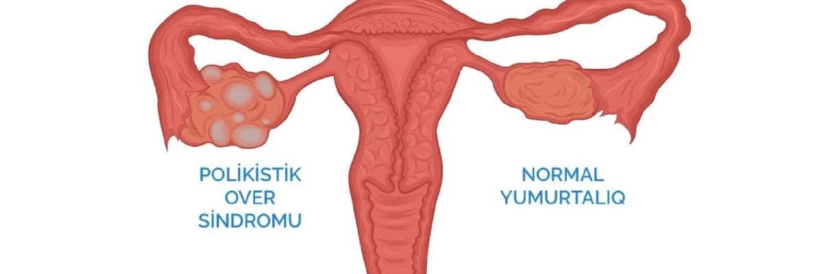 Polikistik yumurtalıq sindromu