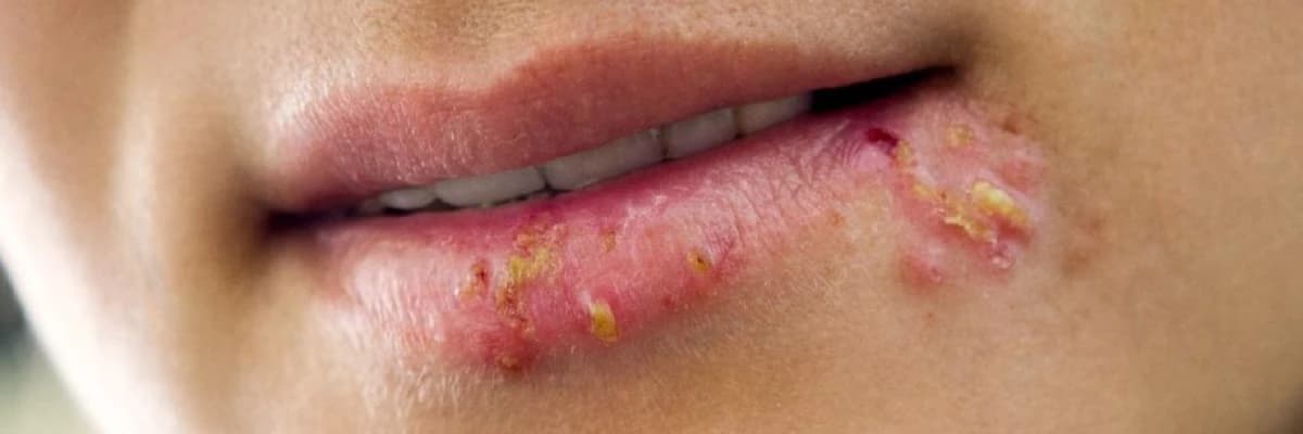 Herpes Simpleks Virusunun Səbəbləri, Simptomları və Müalicə Yolları