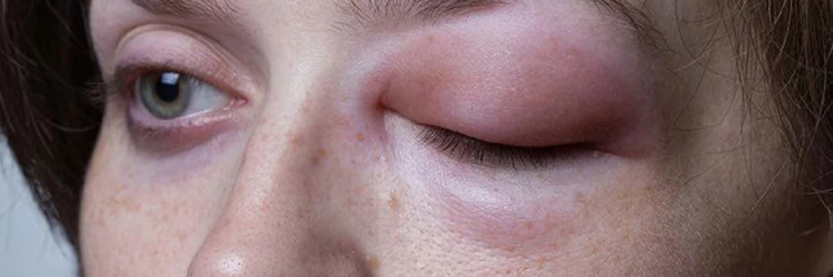 Herediter angioödem