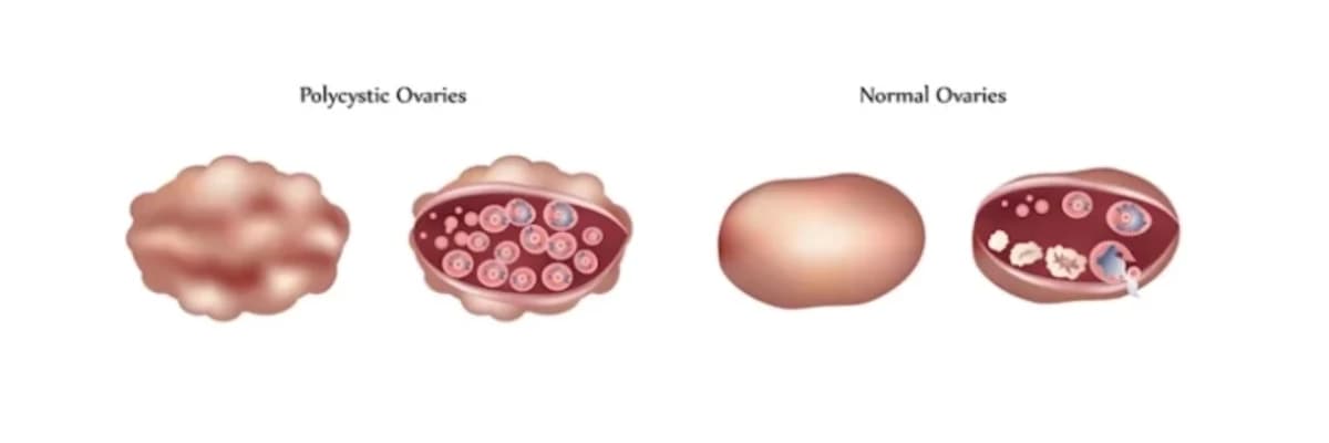 Polikistik Yumurtalıq Sindromu (PCOS): Simptomlar, Səbəblər və Müalicə