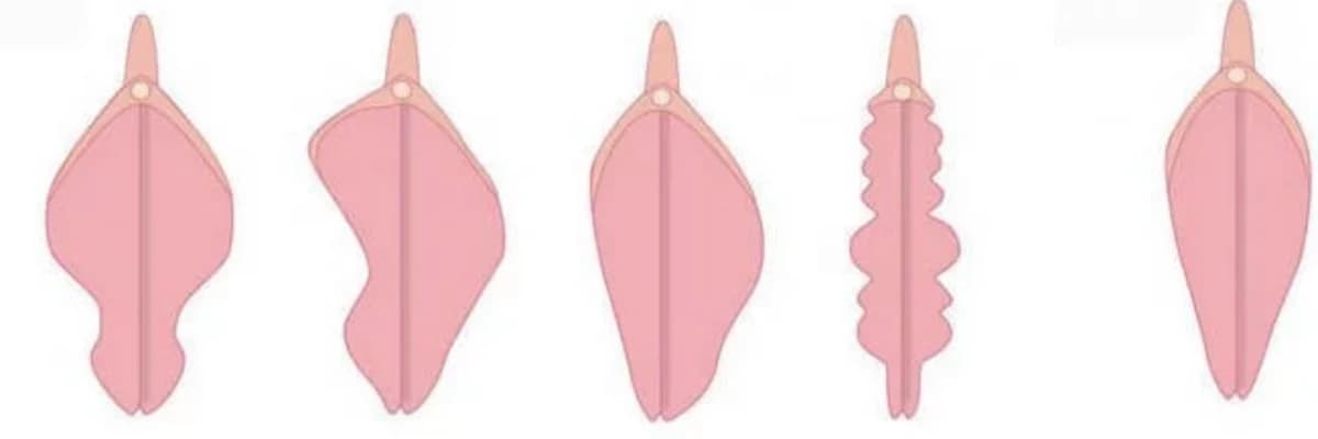 Qız uşaqlarında labial sinexiya.( Kiçik cinsiyət dodaqlarının bitişməsi)