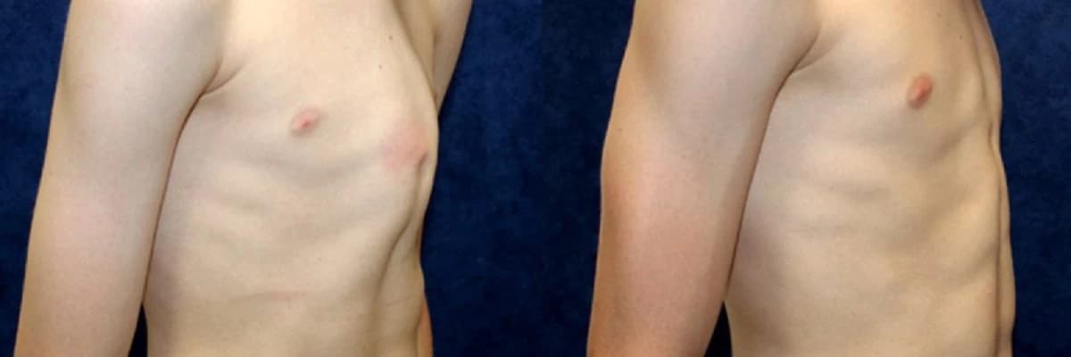 Uşaqlarda Pektus Xəstəliyi: Diaqnoz və Müalicə