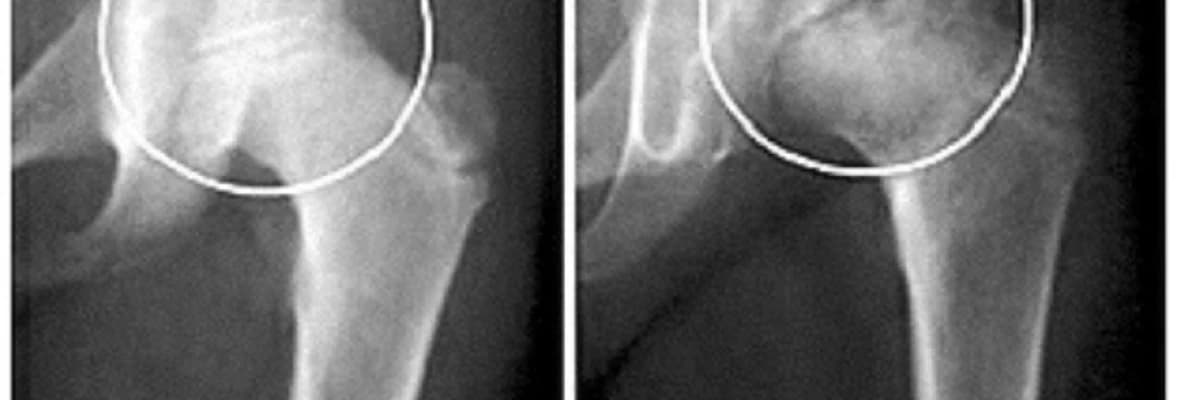 Perthes xəstəliyi haqqında