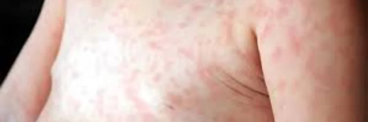 Kəmərləyici Dermatoz: Bir Dəri Xəstəliyinin Nəzərə Alınması