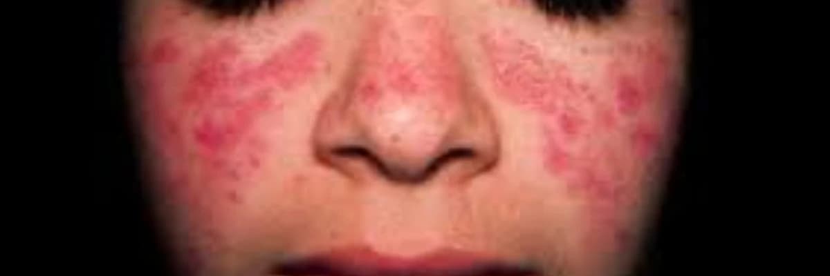 Lupus/sistemik lupus eritematosus