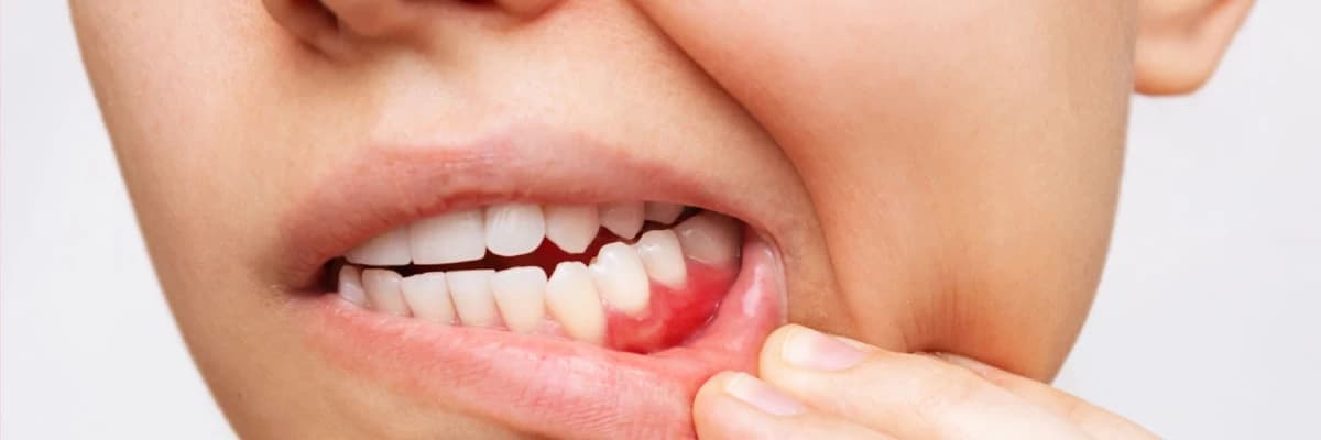 Diş Əti Qanaması: Səbəbləri, Müalicəsi və Qarşısının Alınması