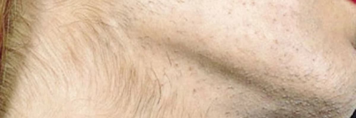 Hirsutizm haqqında xesteliyi