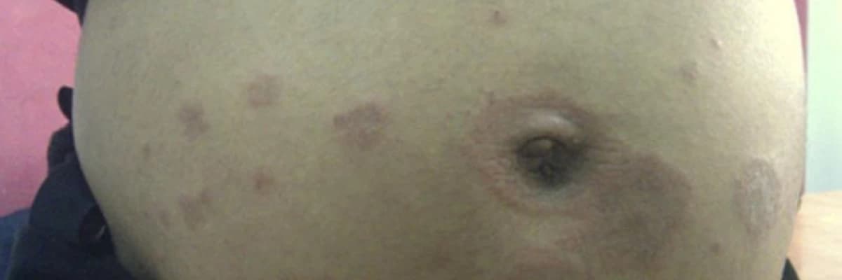 Hamiləlik Pemfiqoidi (Pemphigoid Gestationis)