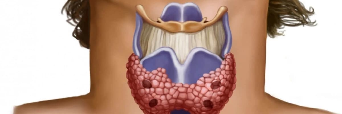 Zəhərli Zob - Qalxanabənzər vəz