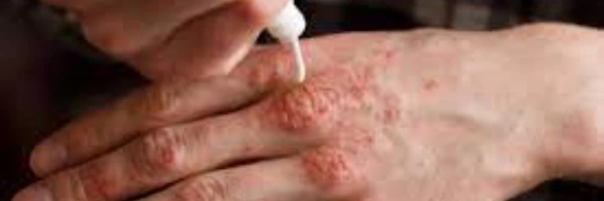 Delusional Parasitosis: Psixogen Parazitozun Anlaşılması və Müalicəsi