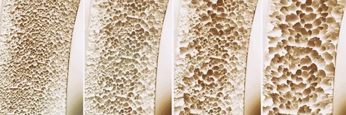 Osteoporoz