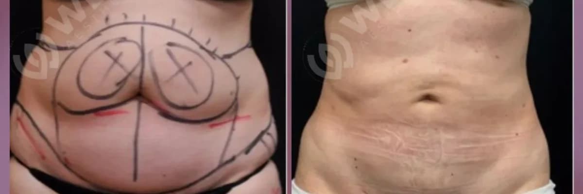 Piylərin çıxarılması (lazer lipoliz - liposaksiya)