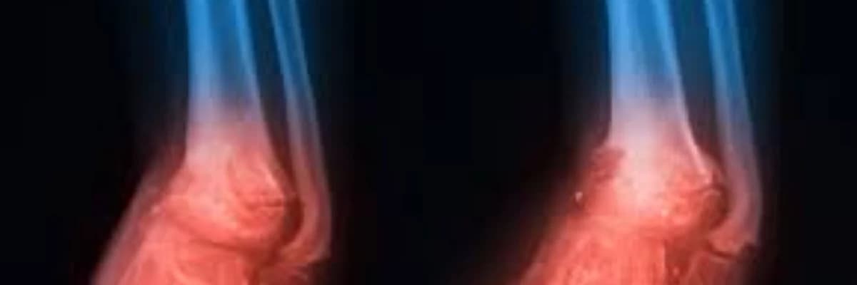 Osteomielitlərin cərrahi və konservativ müalicəsi