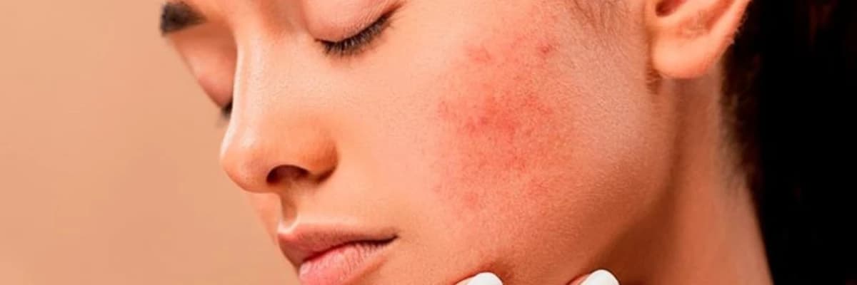 Kosmetik İstifadəyə Görə Sızanaqlar: Acne Cosmetica və Qarşısının Alınması
