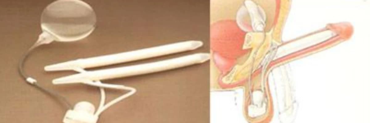 Erektil disfunksiya (ereksiya problemləri)