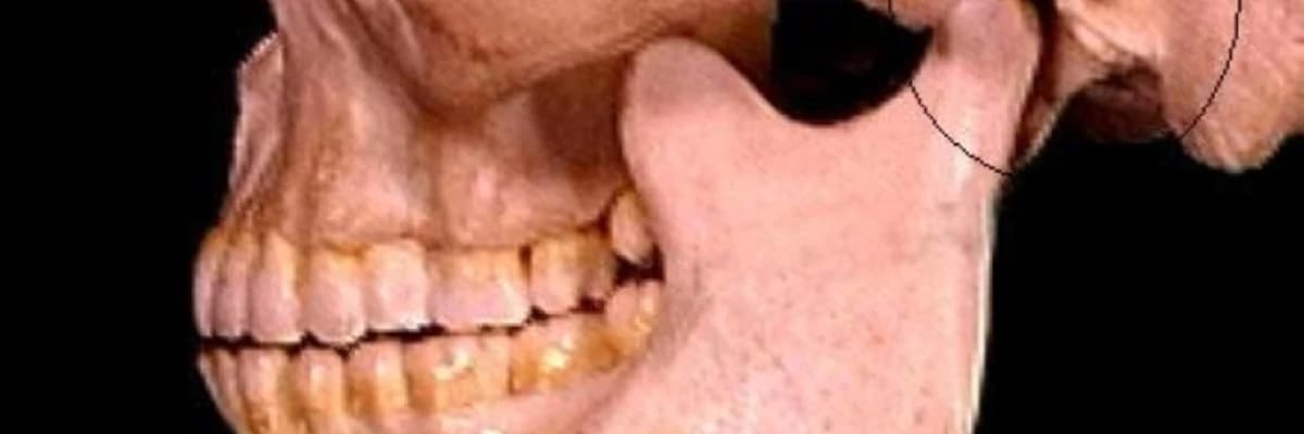 Temporomandibular Eklem (TMJ) xəstəliyi: