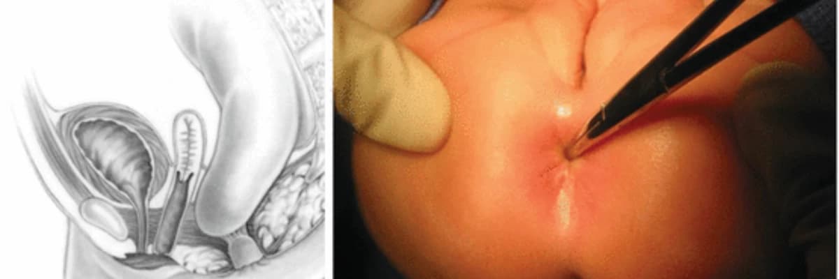 Anal Atreziya: Anadangəlmə Bağırsaq Anomaliyası